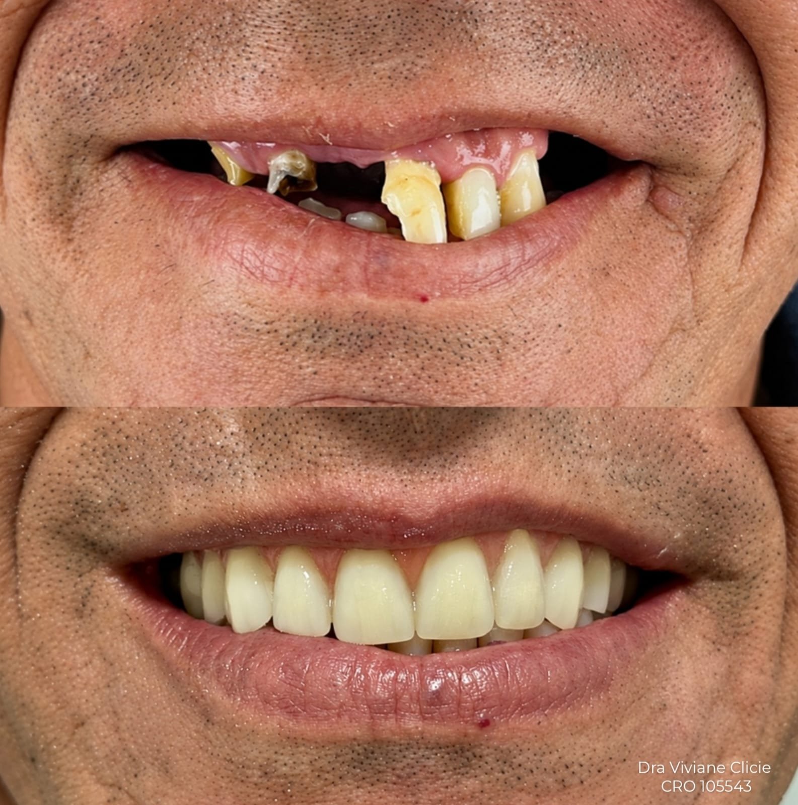 Prótese protocolo 4